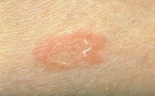 Ροδόχρους πιτυρίαση: Τι είναι και πώς θα την αντιμετωπίσετε