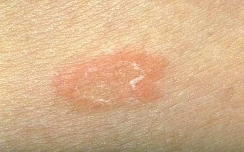 Ροδόχρους πιτυρίαση: Τι είναι και πώς θα την αντιμετωπίσετε