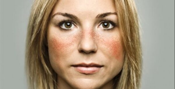 Ανακάλυψαν ένζυμο που αυξάνεται στο αίμα των ασθενών με “λύκο”