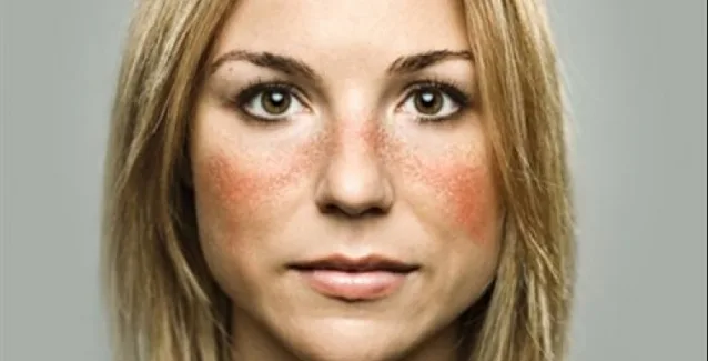 Ανακάλυψαν ένζυμο που αυξάνεται στο αίμα των ασθενών με “λύκο”