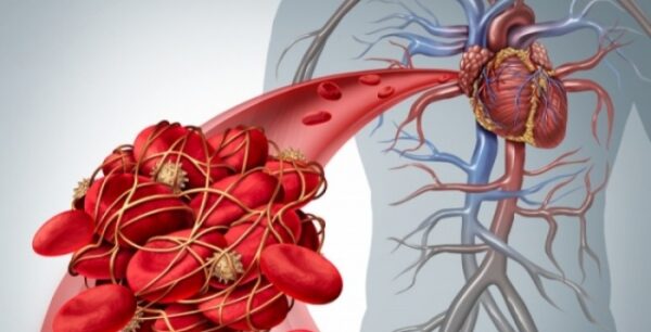 Πνευμονική εμβολή: Ποιοι άνδρες διατρέχουν μεγαλύτερο κίνδυνο