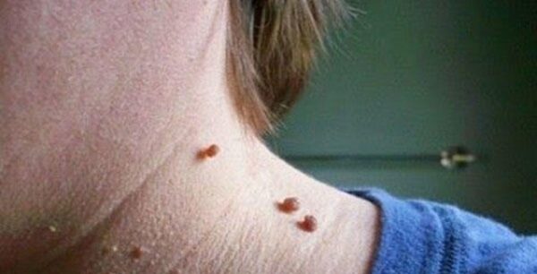 Ετσι θα αφαιρέσετε γρήγορα τις μικροσκοπικές ελιές από το δέρμα με μόνο ένα συστατικό!