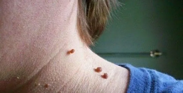 Ετσι θα αφαιρέσετε γρήγορα τις μικροσκοπικές ελιές από το δέρμα με μόνο ένα συστατικό!