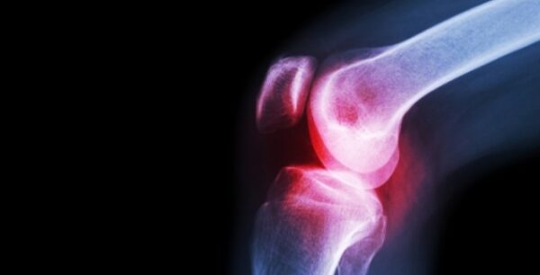 Αυτές είναι οι 3 τροφές που προκαλούν πόνους στις αρθρώσεις