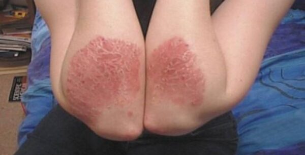 Ψωρίαση,συμπτώματα,θεραπεία