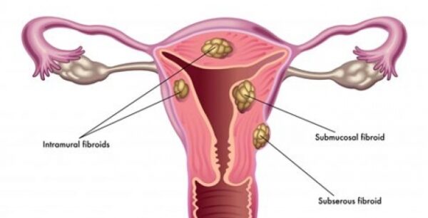Η υψηλή τεστοστερόνη στις γυναίκες αυξάνει τον κίνδυνο ινομυωμάτων