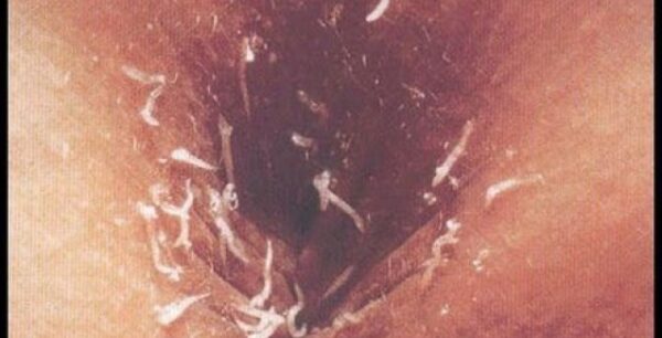 Συμπτώματα που δείχνουν παράσιτα στο έντερο