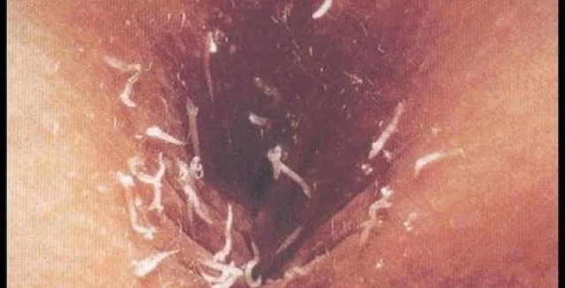 Συμπτώματα που δείχνουν παράσιτα στο έντερο