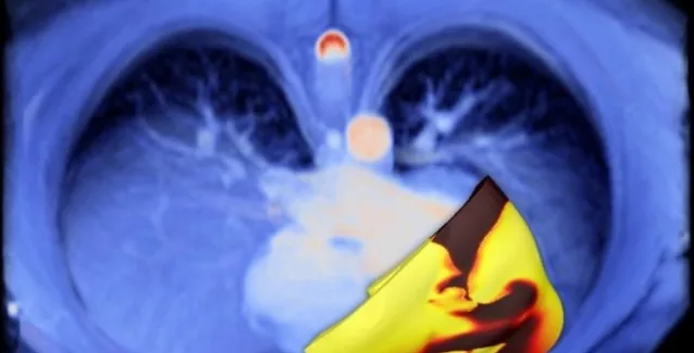 Καρδιές 3D προβλέπουν την αρρυθμία