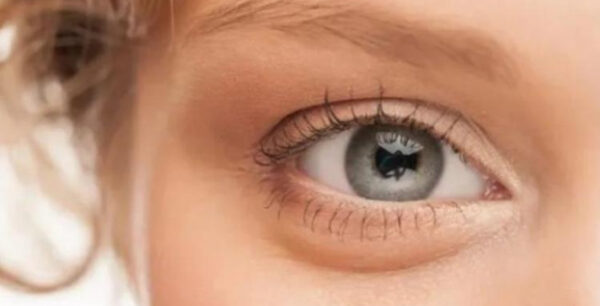 Κριθαράκι στο μάτι: Αντιμετώπιση&πρόληψη