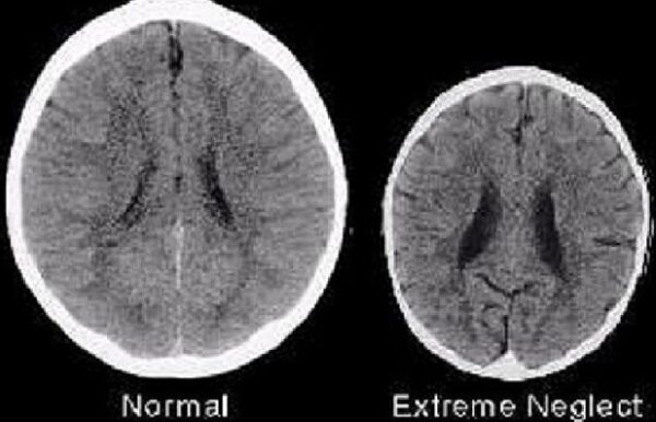 Έρευνα : Δείτε τον εγκέφαλο πως είναι όταν δέχεται Αγάπη και χωρίς Αγάπη