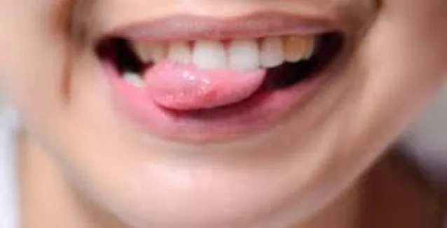 Άφθες: Δες τι μπορείς να κάνεις για να τις προλάβεις και να τις εξαφανίσεις