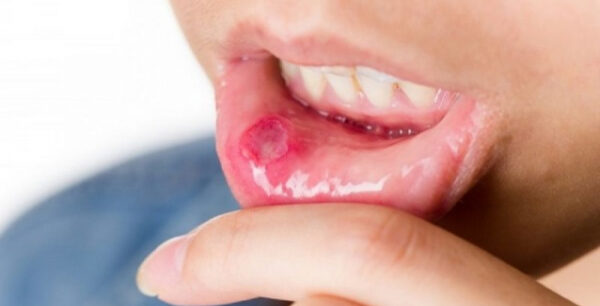 Άφθες στο στόμα: Τι πρέπει να ξέρετε για την μυκωτική στοματίτιδα