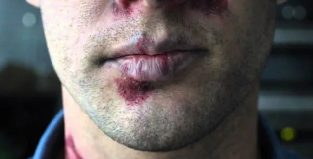 AIDS / HIV: Τα συμπτώματα που επιβάλλεται να γνωρίζουμε όλοι!