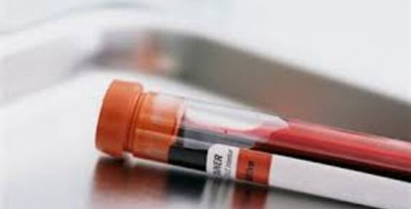 Αυτό δεν το ξέραμε για την εξέταση χοληστερίνης μέχρι τώρα