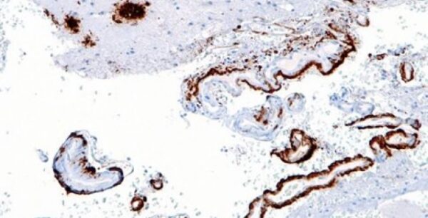 Νέες ενδείξεις για «μεταδοτική μορφή» της Αλτσχάιμερ