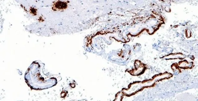 Νέες ενδείξεις για «μεταδοτική μορφή» της Αλτσχάιμερ