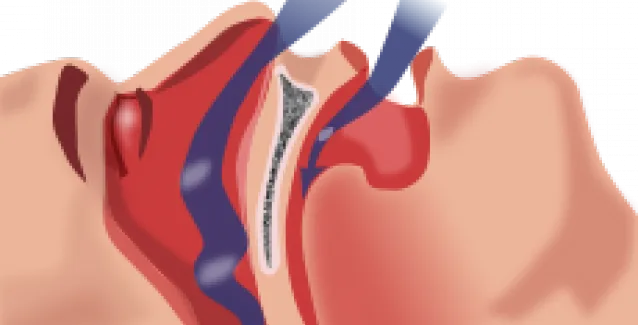 Επικίνδυνη αποφρακτική υπνική άπνοια και κολπική μαρμαρυγή