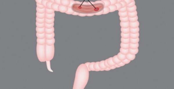 Το λαχανικό που προστατεύει από τον καρκίνο του εντέρου