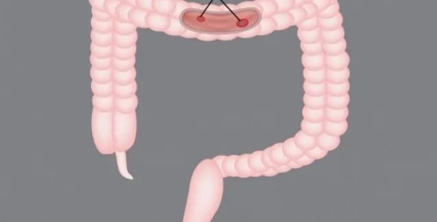 Το λαχανικό που προστατεύει από τον καρκίνο του εντέρου