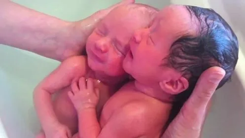 Σπάνια ημι-πανομοιότυπα δίδυμα από ένα ωάριο και δύο σπερματοζωάρια