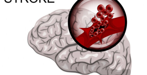 Δεύτερο εγκεφαλικό: Ποιοι διατρέχουν μεγαλύτερο κίνδυνο και γιατί