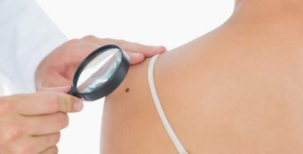 Αυτό είναι το γονίδιο που προκαλεί κακόηθες μελάνωμα