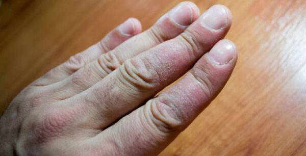 Ψωρίαση: Τι την προκαλεί & ποιοι είναι οι τύποι της