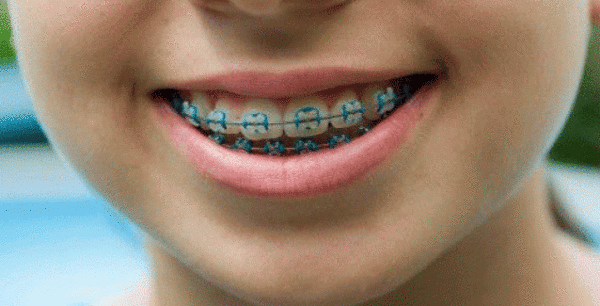 Μήπως το παιδί σας χρειάζεται σιδεράκια;