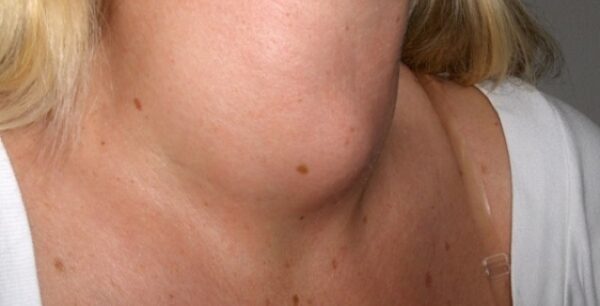 Βρογχοκήλη: Τι είναι, αίτια και συμπτώματα