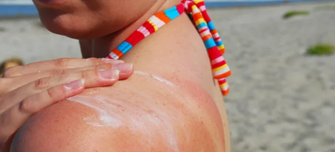 ΗΛΙΑΚΑ ΕΓΚΑΥΜΑΤΑ: Πώς τα αντιμετωπίζουμε για να απολαύσουμε ανώδυνα τις διακοπές μας