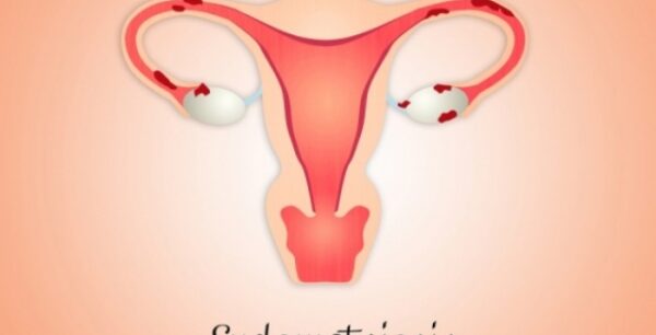 Ενδομητρίωση: Πόσο αυξάνει τον κίνδυνο καρκίνου