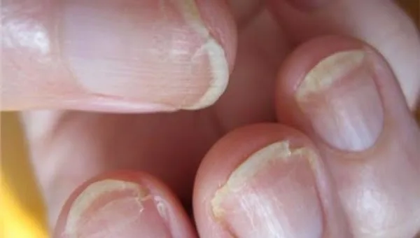 Τι λένε τα νύχια για την υγεία σας;