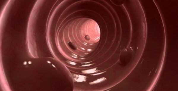 Πολύποδες εντέρου: Ποιες τροφές αυξάνουν τον κίνδυνο