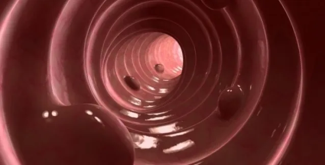 Πολύποδες εντέρου: Ποιες τροφές αυξάνουν τον κίνδυνο