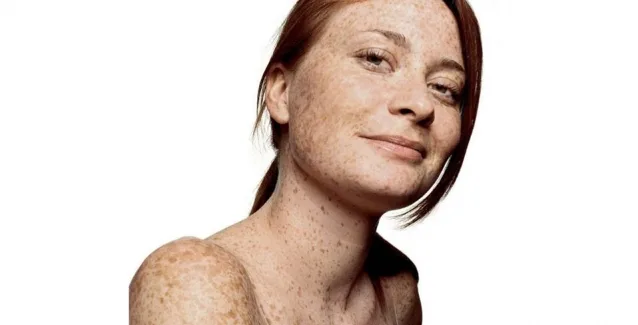 Κρεατοελιές στο δεξιό βραχίονα:Σημάδι πιθανής ανάπτυξης καρκίνου