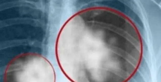 Βρέθηκε το εμβόλιο για τον καρκίνο του πνεύμονα