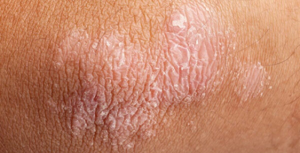 Οι τέσσερις σοβαρές ασθένειες που συνδέονται με την ψωρίαση