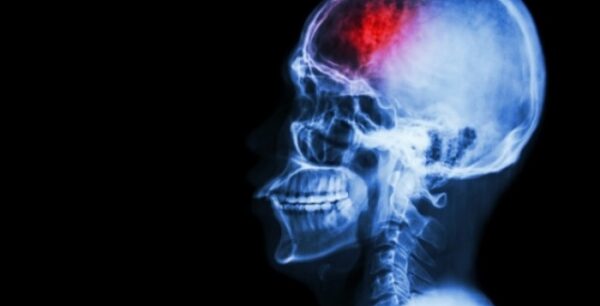 Αυτή η ουσία αποτρέπει τα εγκεφαλικά