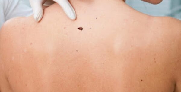 Τα προειδοποιητικά σημάδια του καρκίνου του δέρματος