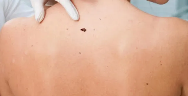 Τα προειδοποιητικά σημάδια του καρκίνου του δέρματος