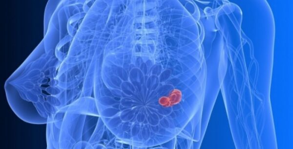 Καρκίνος μαστού: Ποια φρούτα και λαχανικά μειώνουν τον κίνδυνο 40-60%