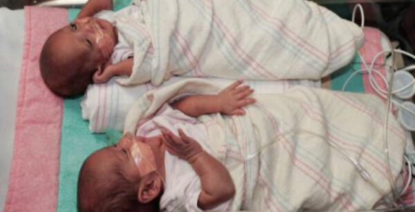 Μικρότερος ο κίνδυνος θανάτου για τα δίδυμα που γεννιούνται την 37η εβδομάδα της κύησης