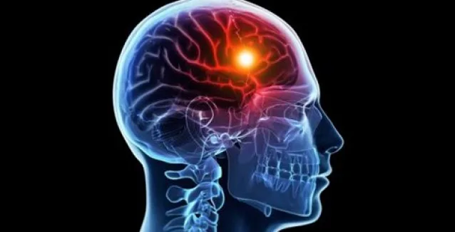 Ανακαλύφθηκε γονίδιο που αυξάνει τον κίνδυνο εγκεφαλικού επεισοδίου