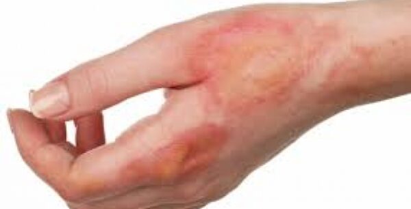 Καινοτόμες λύσεις στην αντιμετώπιση των χημικών εγκαυμάτων