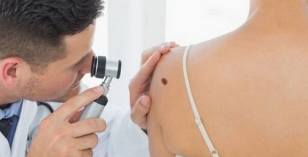 Αυτοεξέταση δέρματος: Ποια είναι τα χαρακτηριστικά μιας φυσιολογικής ελιάς