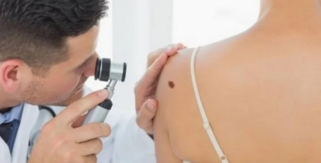 Αυτοεξέταση δέρματος: Ποια είναι τα χαρακτηριστικά μιας φυσιολογικής ελιάς