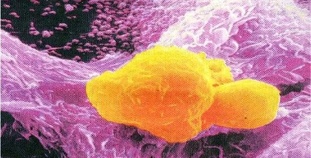 Η ελονοσία αντιμάχεται τον καρκίνο