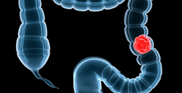 Καρκίνος παχέος εντέρου: Τι ρόλο παίζουν τα μικρόβια του στόματος