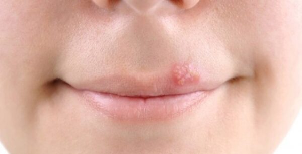 Νέα θεραπεία για τον ιό του έρπη